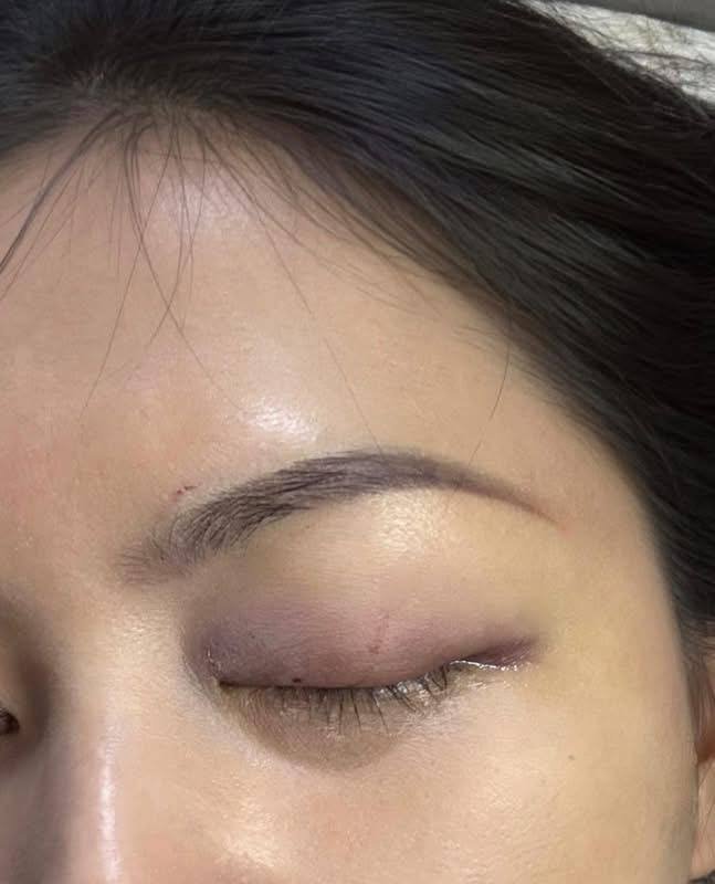 瓶装棕榈糖水冰箱内炸裂 导致一名女性眼部重伤