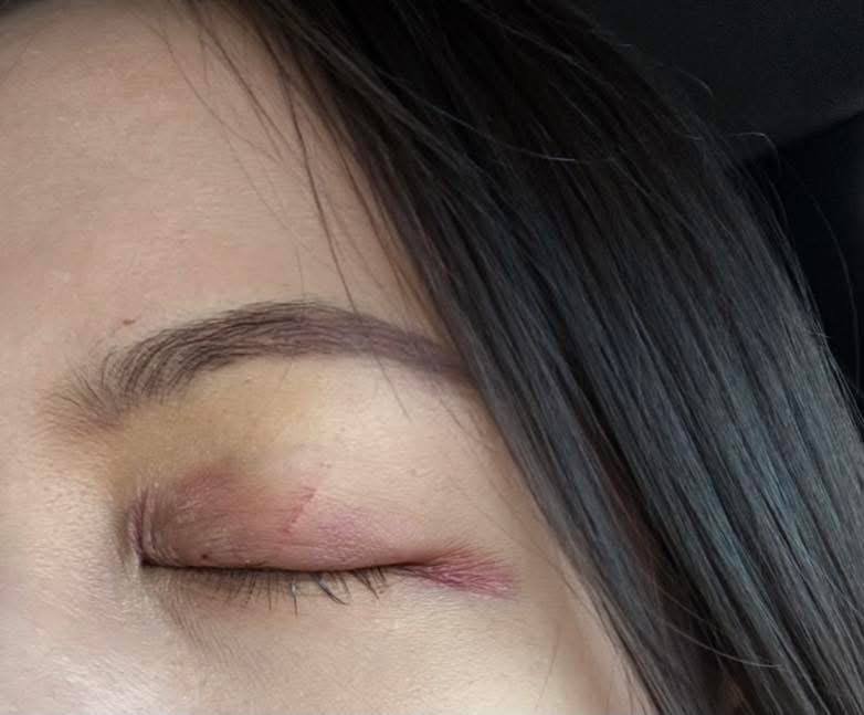 瓶装棕榈糖水冰箱内炸裂 导致一名女性眼部重伤
