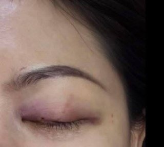 瓶装棕榈糖水冰箱内炸裂 导致一名女性眼部重伤