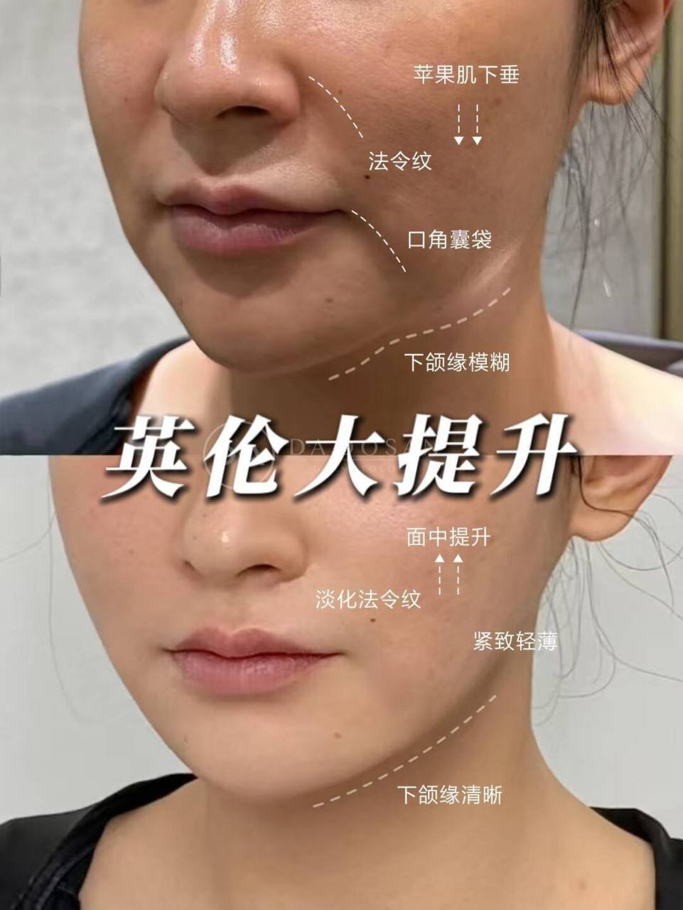 金边西港医美抗衰服务 曼谷吉隆坡多店可约