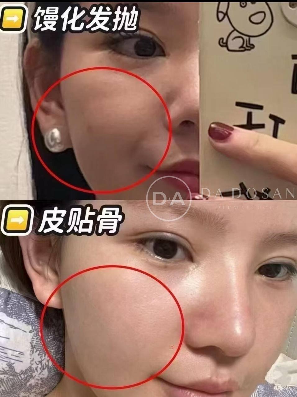 金边医美模特招募 针对面部松弛及轮廓调整
