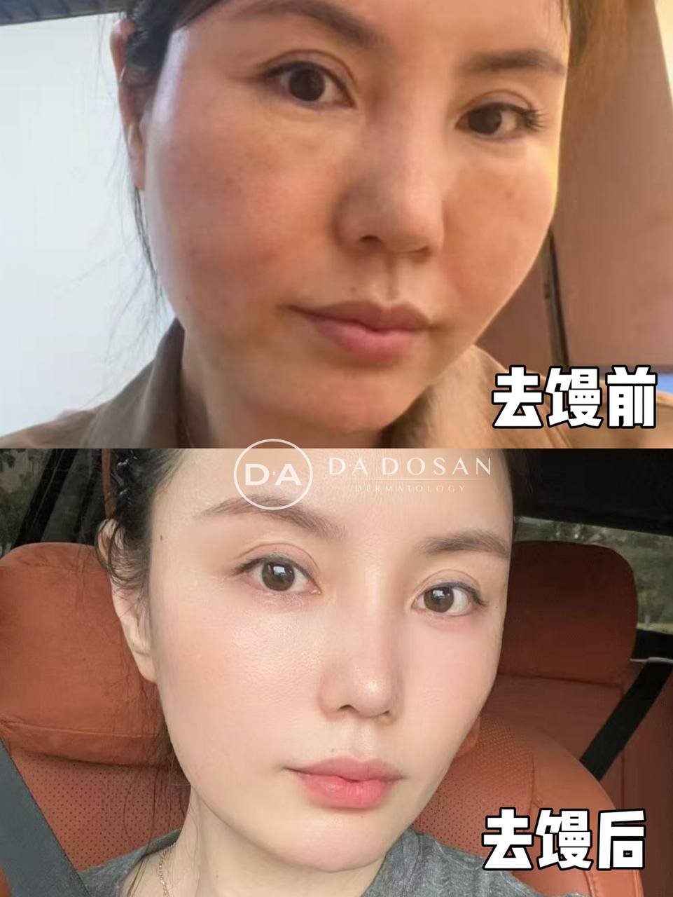 金边医美馒化针秒杀价$398 正规医师操作
