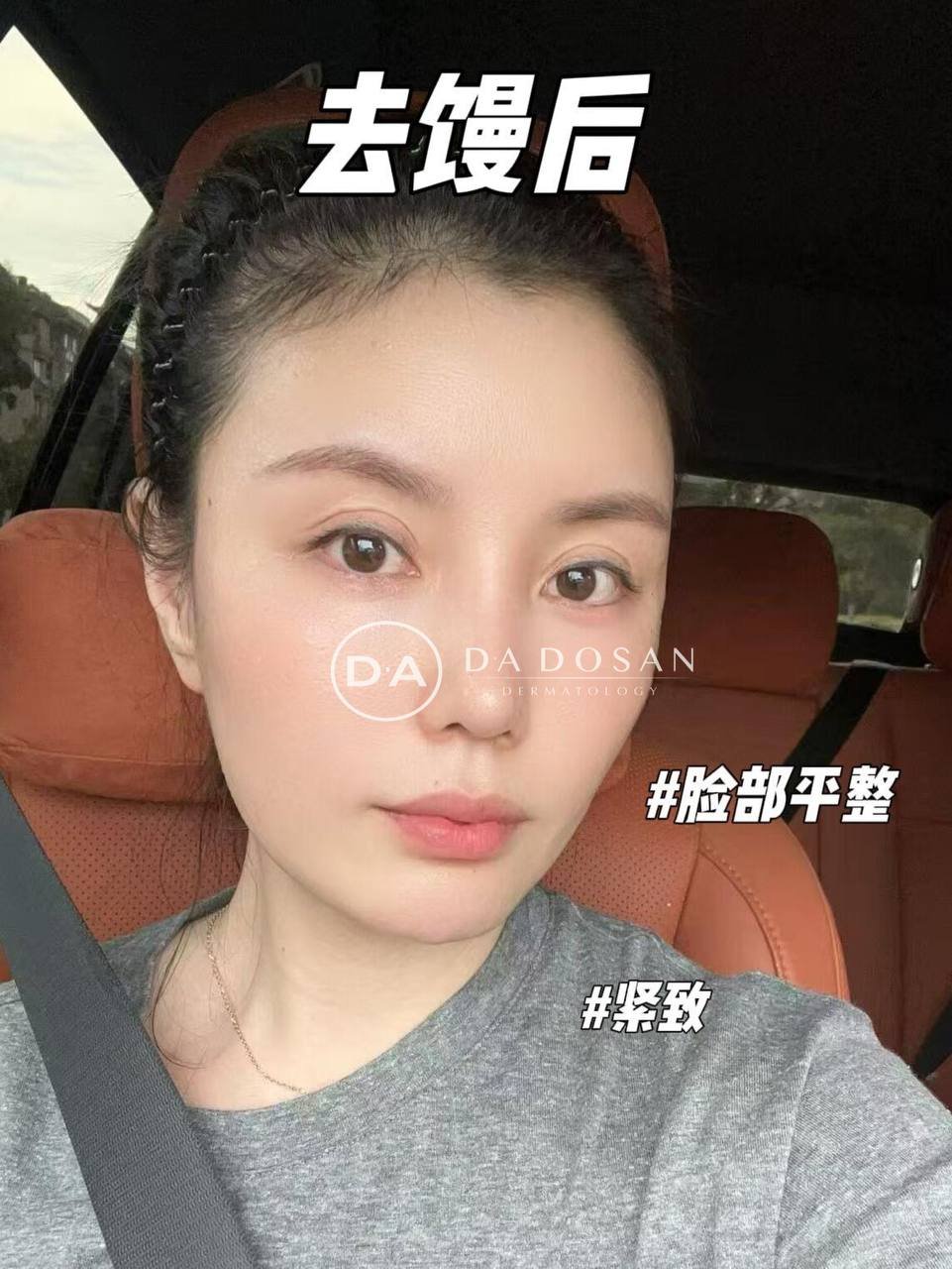 金边医美馒化针秒杀价$398 正规医师操作