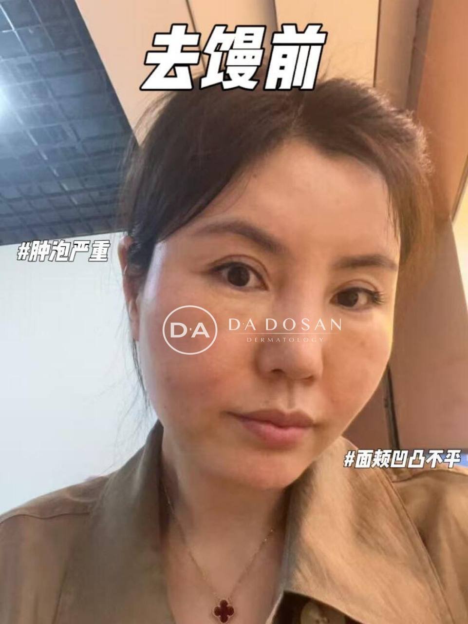 金边医美馒化针秒杀价$398 正规医师操作