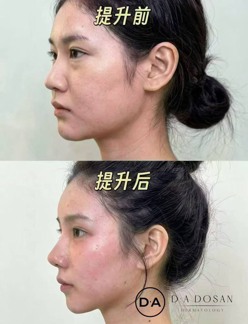 金边医美韧带提升与玻尿酸注射服务 接受低预算定制