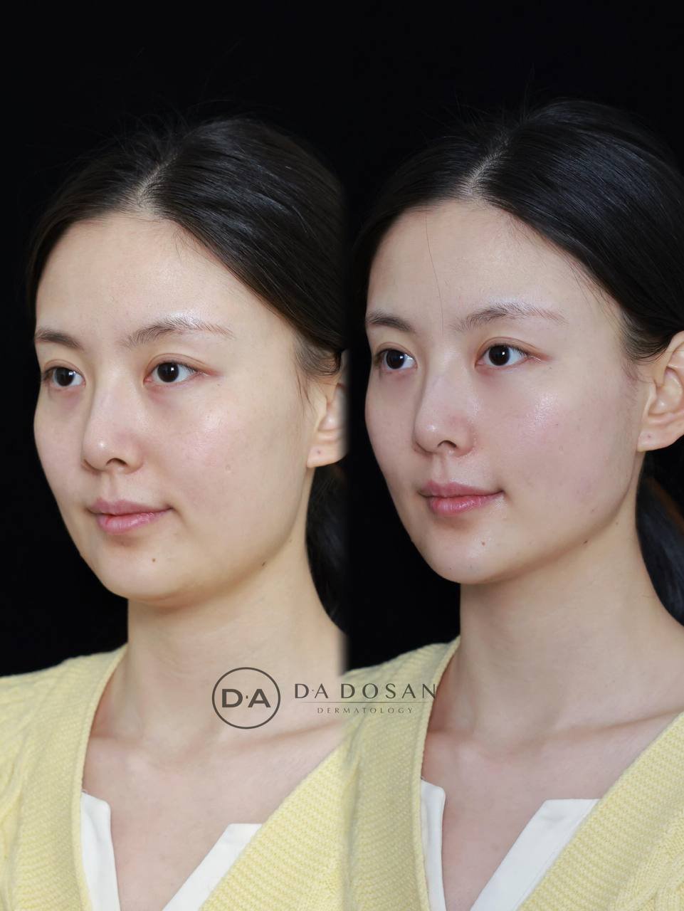 金边轻薄皮贴骨医美项目 30岁以上女性抗衰紧致