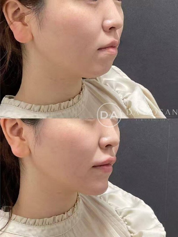 东南亚医美金边西港门店提供医美针剂及骨相脸打造