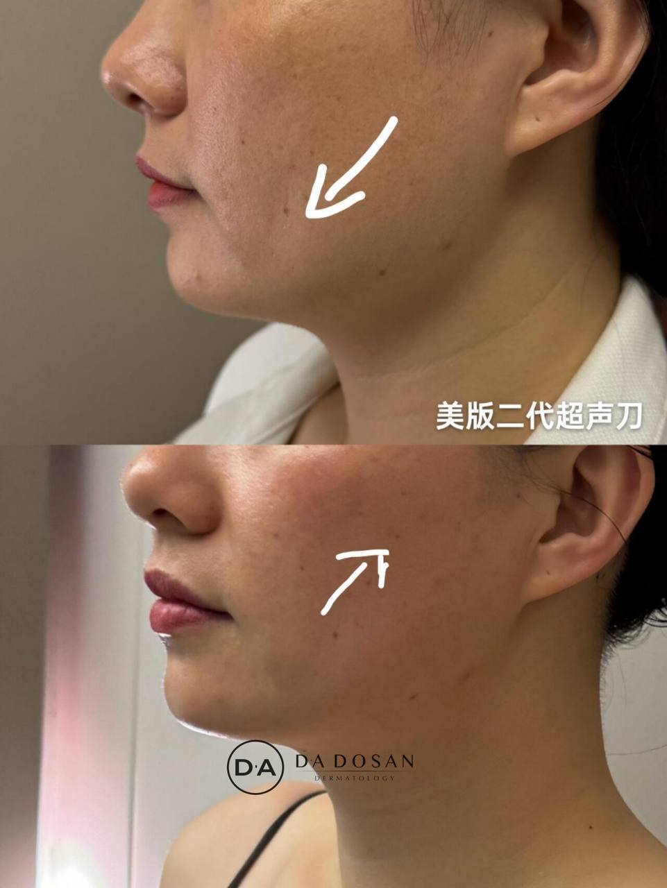 金边2代美版超声刀抗衰 提拉紧致改善面部松弛