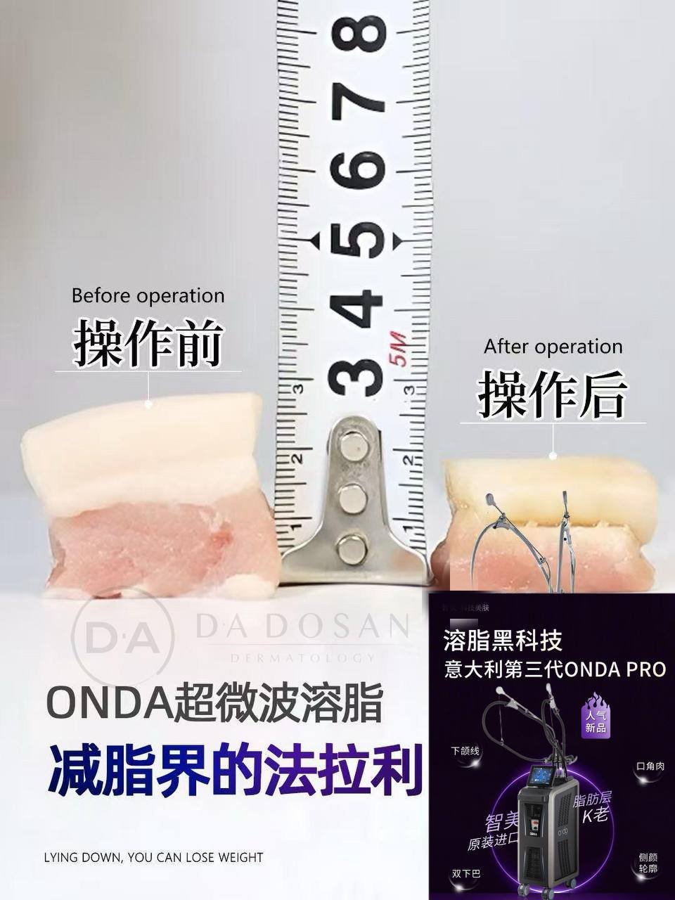 金边西港Onda pro局部减脂服务 懒人塑形