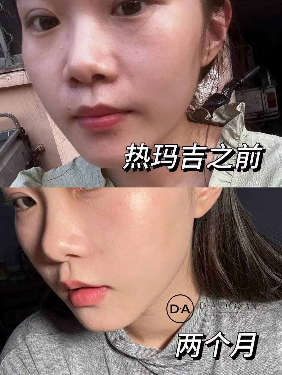 热超联合医美项目上线 改善面部松弛及法令纹