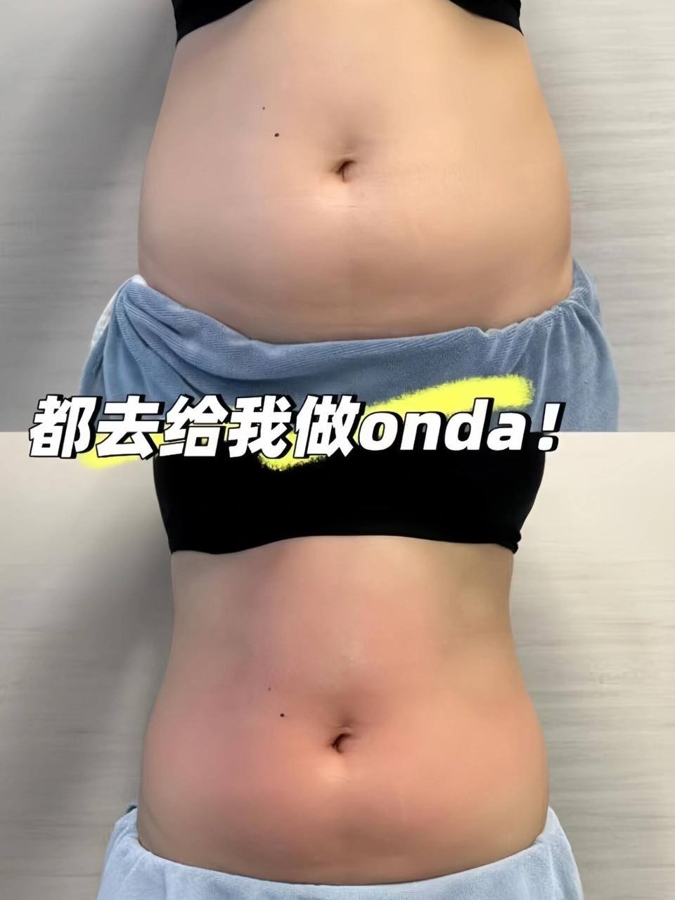 Onda紧致仪器体验套餐 3次仅需$618