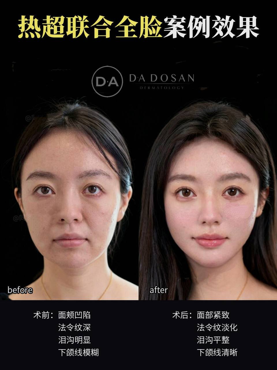 提供热超组合抗衰服务,主打层次互补与双层紧致效果