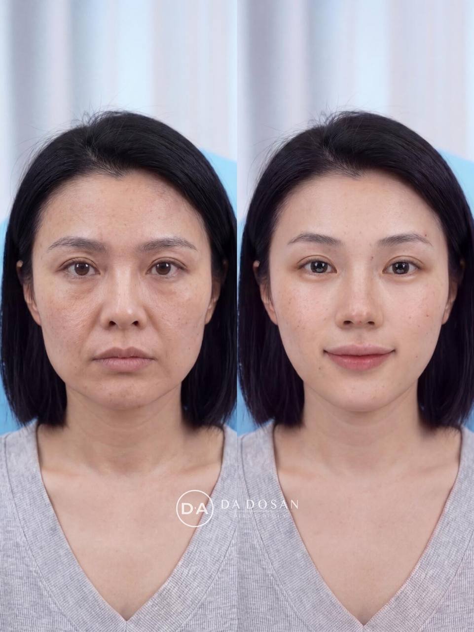 金边医美机构推出超声刀