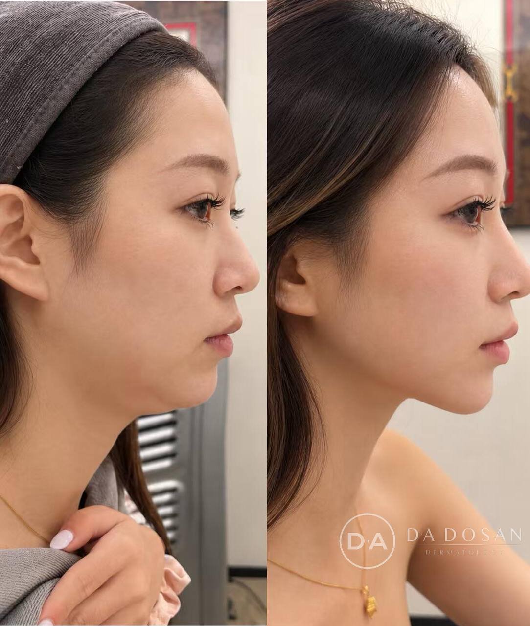 Ondapro医美连锁机构推出618促销活动,3次医美项目套