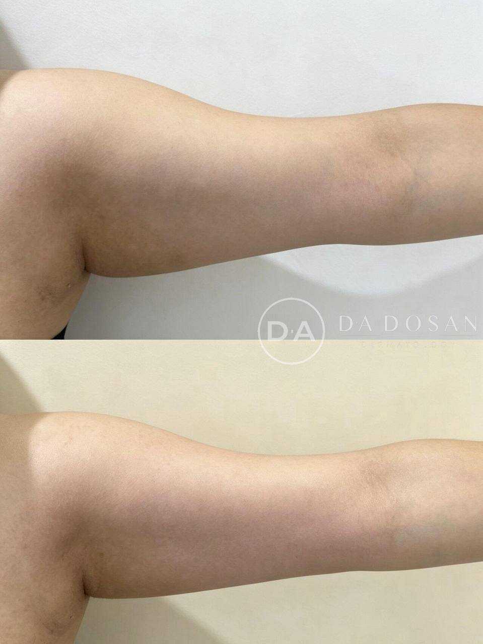 Ondapro医美连锁机构推出618促销活动,3次医美项目套