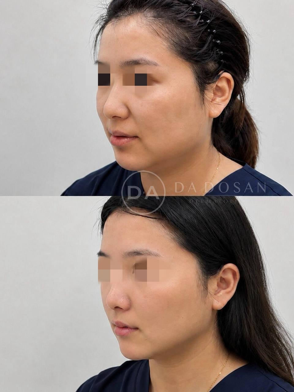 Onda与钛提升医美项目上线 改善脂肪松弛