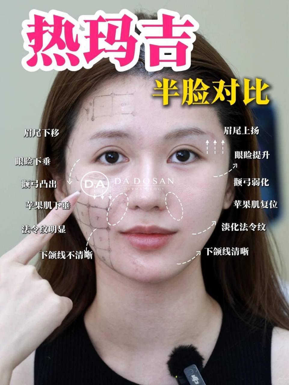 金边5代热玛吉紧致抗衰项目 优惠价$1680 改善面部轮廓