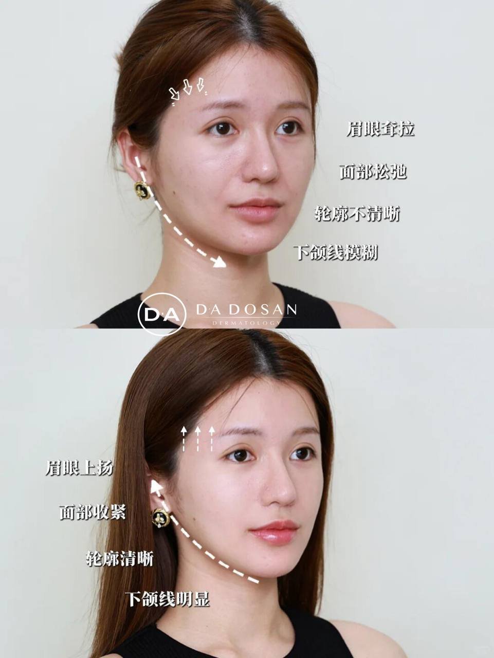 金边5代热玛吉紧致抗衰项目 优惠价$1680 改善面部轮廓