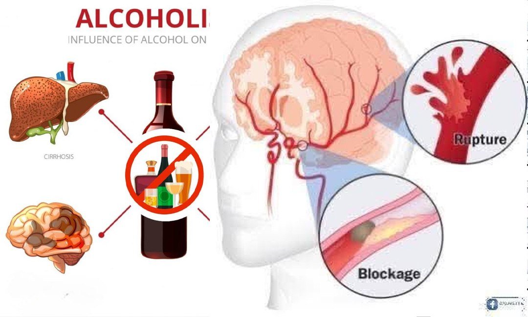 医学研究显示长期饮酒者70%面临严重脑部问题