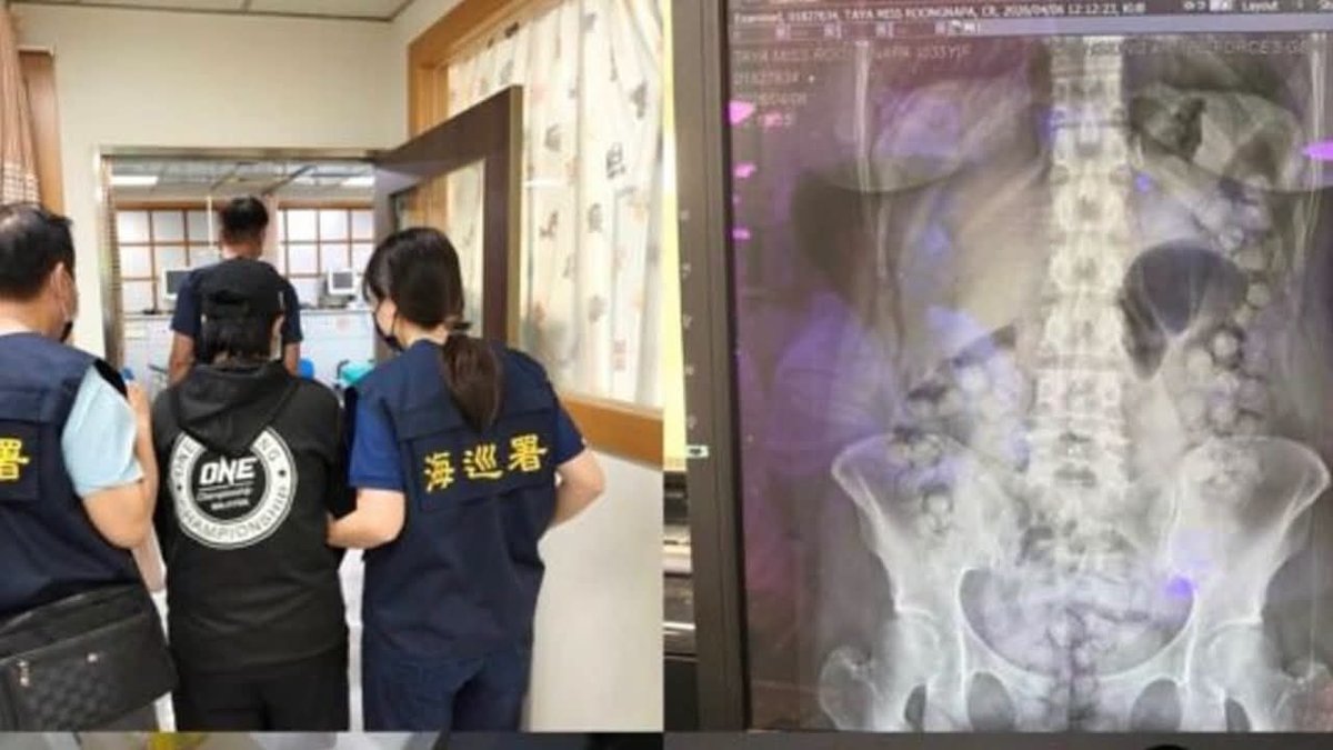 一名泰国女子因体内藏毒72粒海洛因在台湾机场被捕,面临严重法