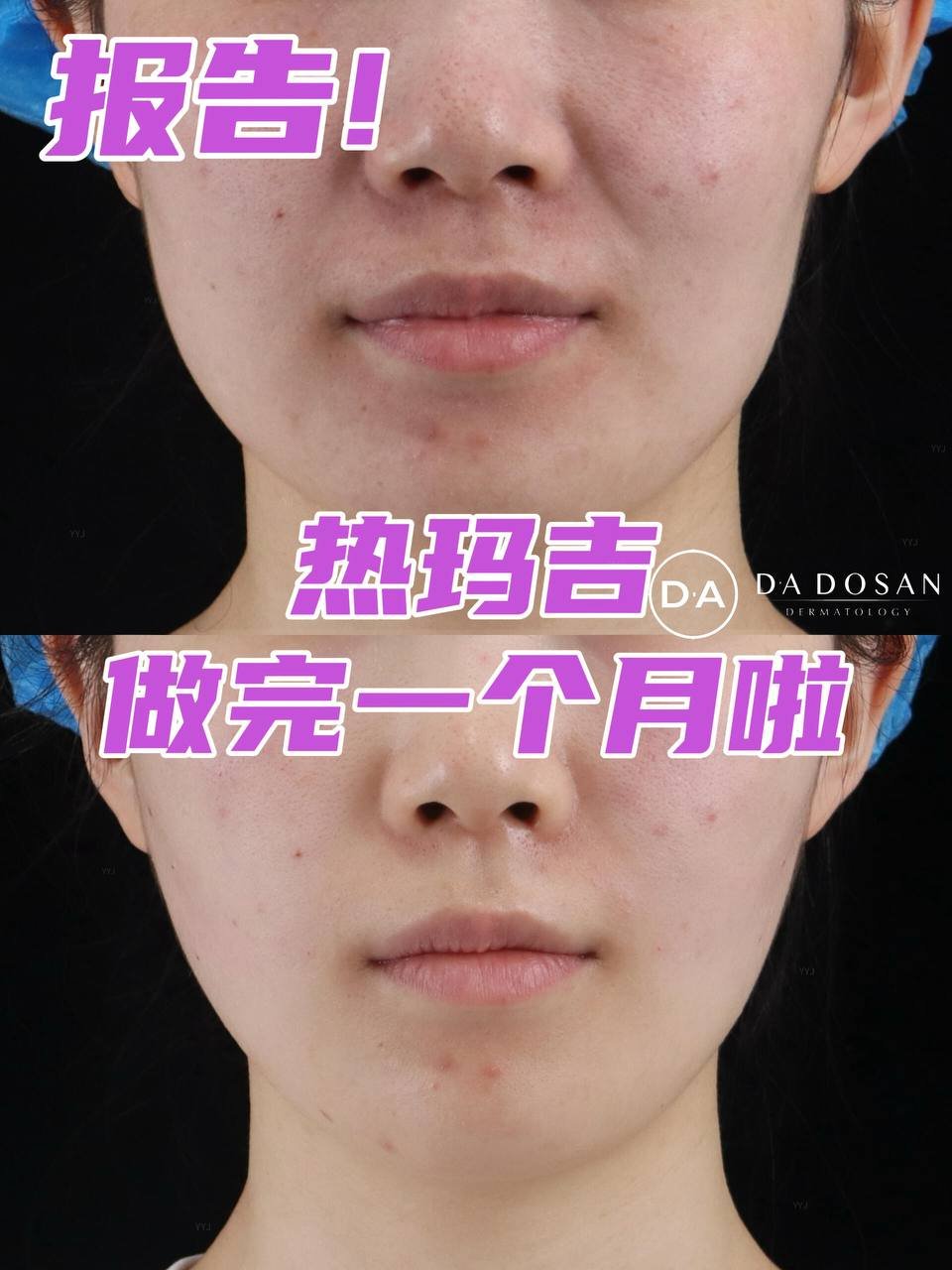 第五代热玛吉面部抗衰 柬埔寨等多地服务