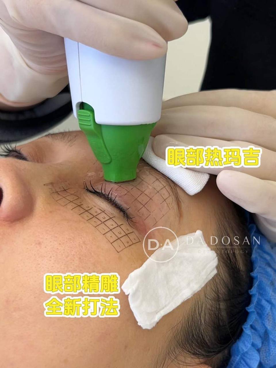 第五代热玛吉面部抗衰 柬埔寨等多地服务
