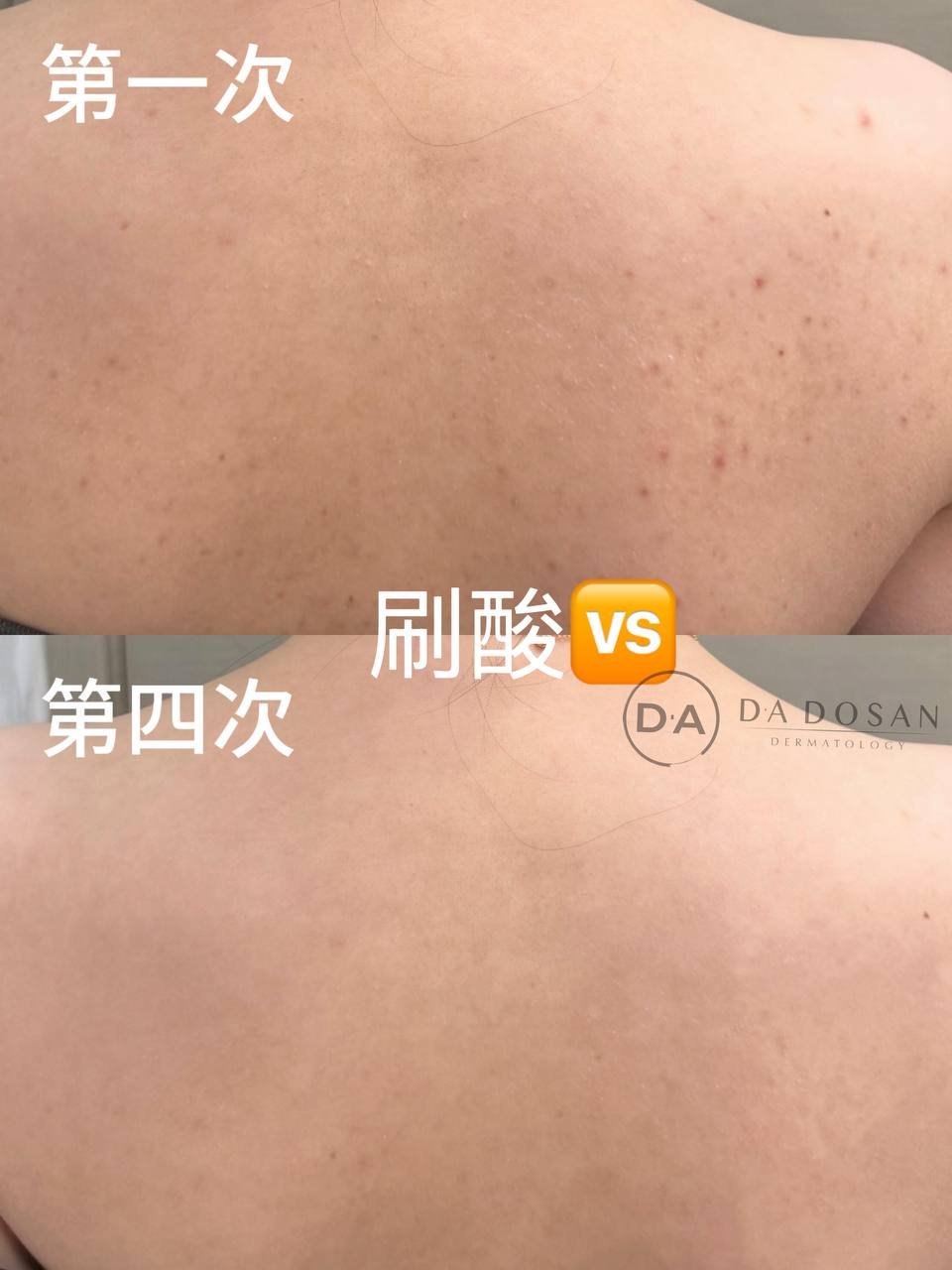 DA特调酸换肤服务 改善痘印黑头 柬埔寨多地可约