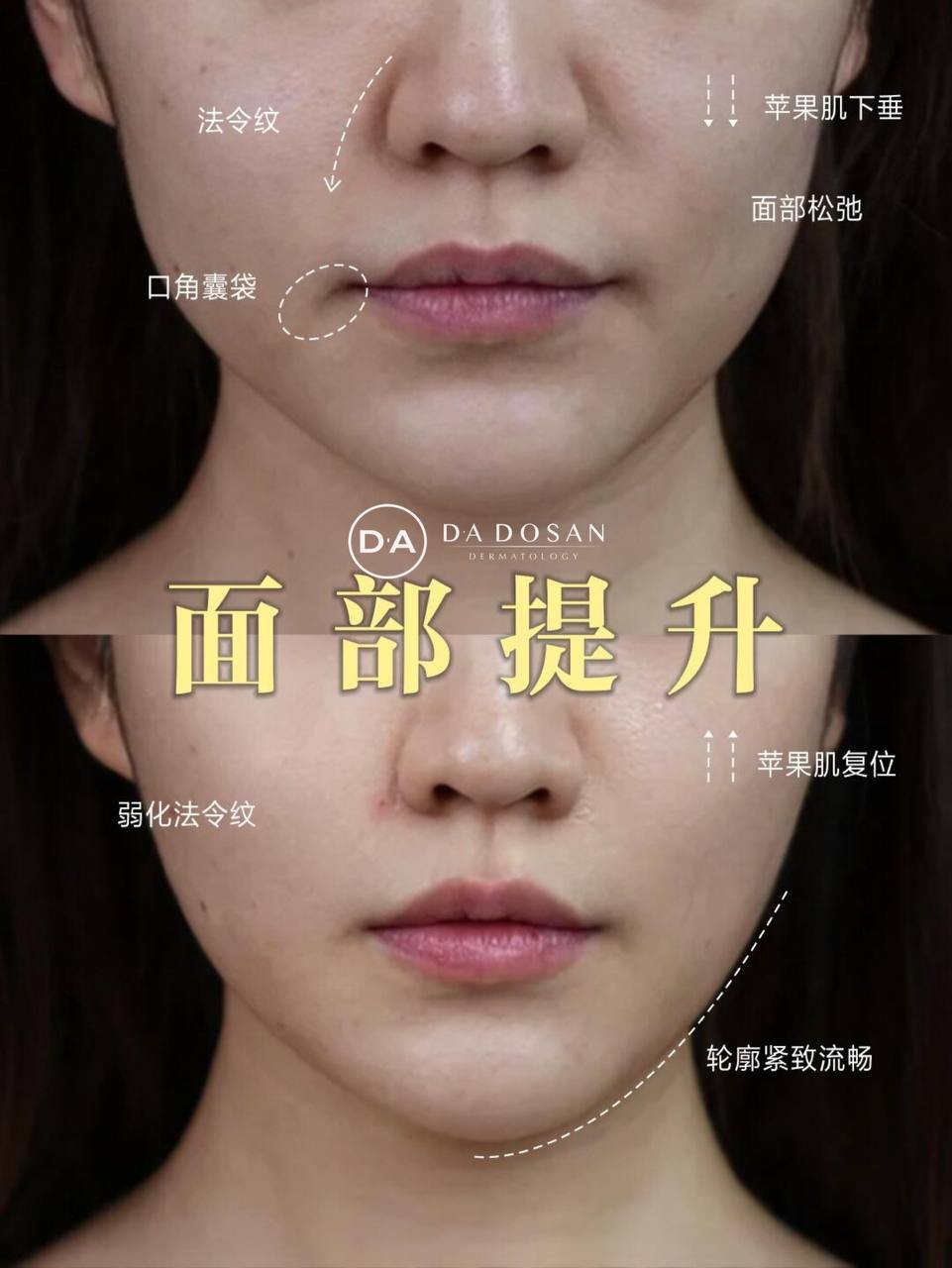 金边英伦大提升抗衰项目 3次卡提拉面部轮廓