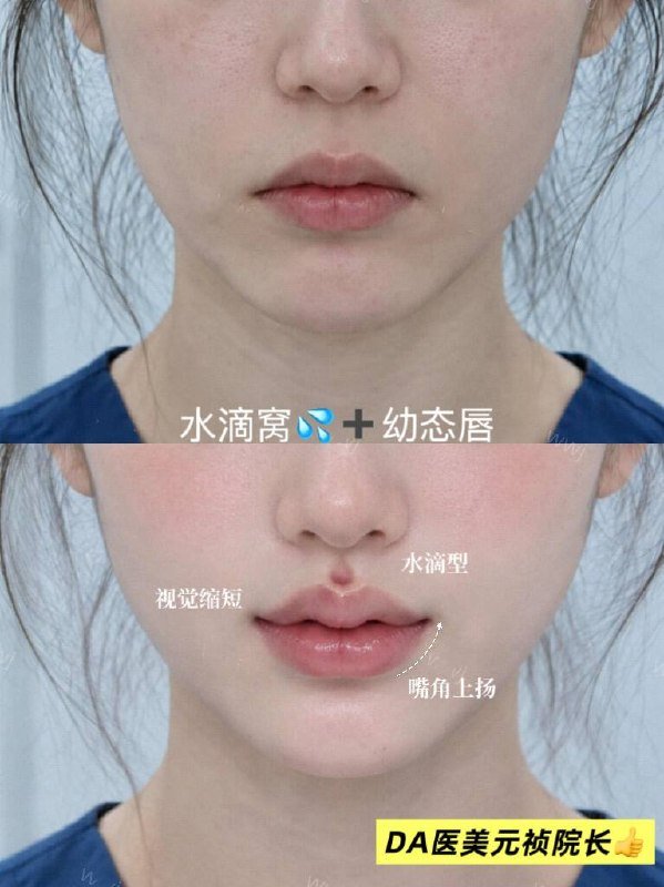 灵动水滴窝与元气幼态唇医美服务 24小时咨询