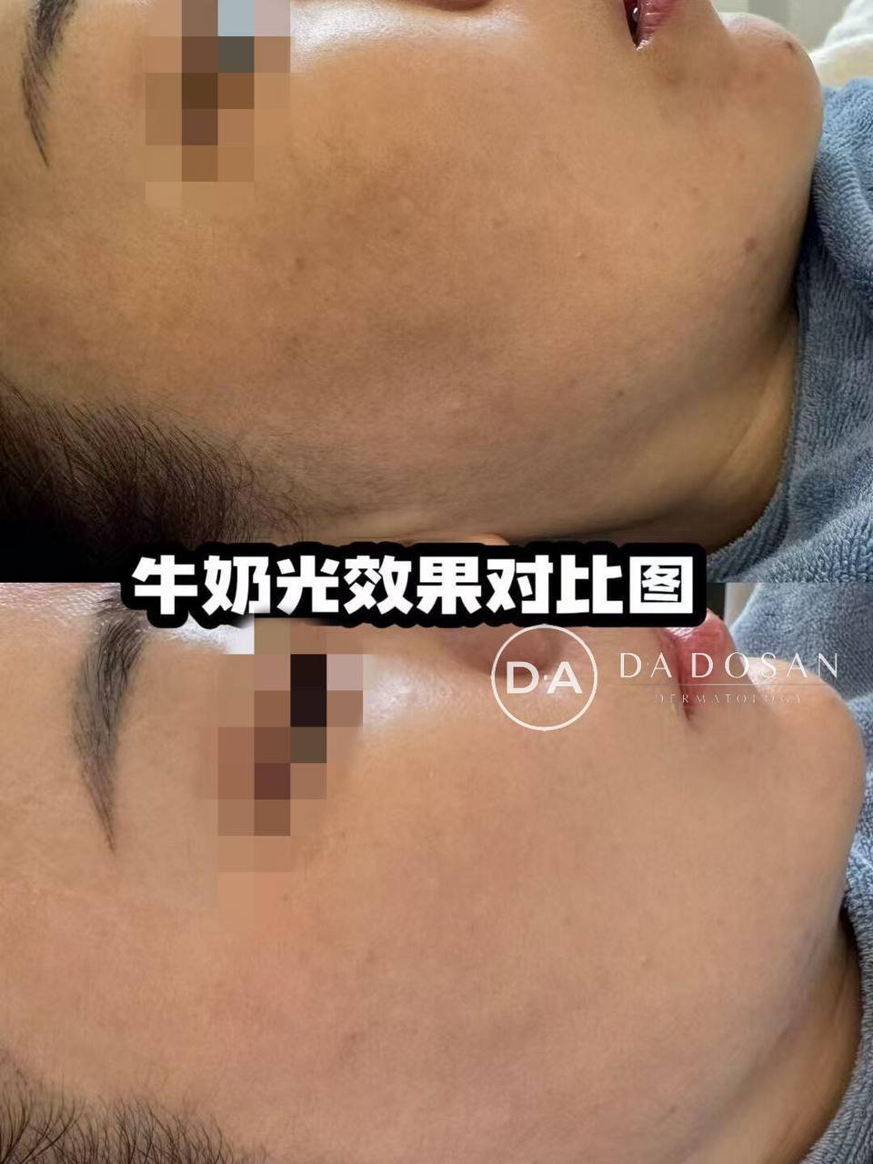 美容光电年卡$999 不限次数 覆盖多国门店