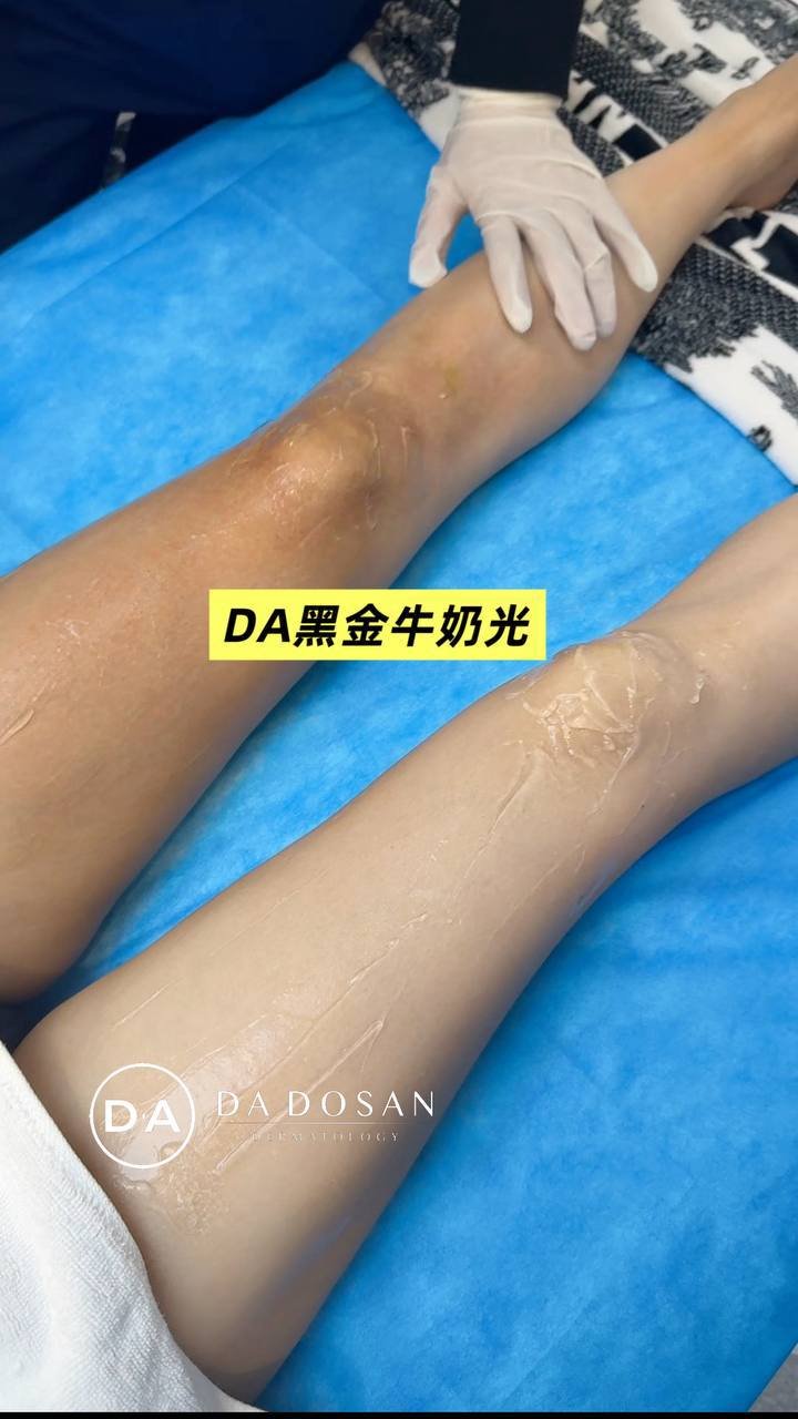 美白光电年卡$999 不限次数 柬韩泰等多地可用