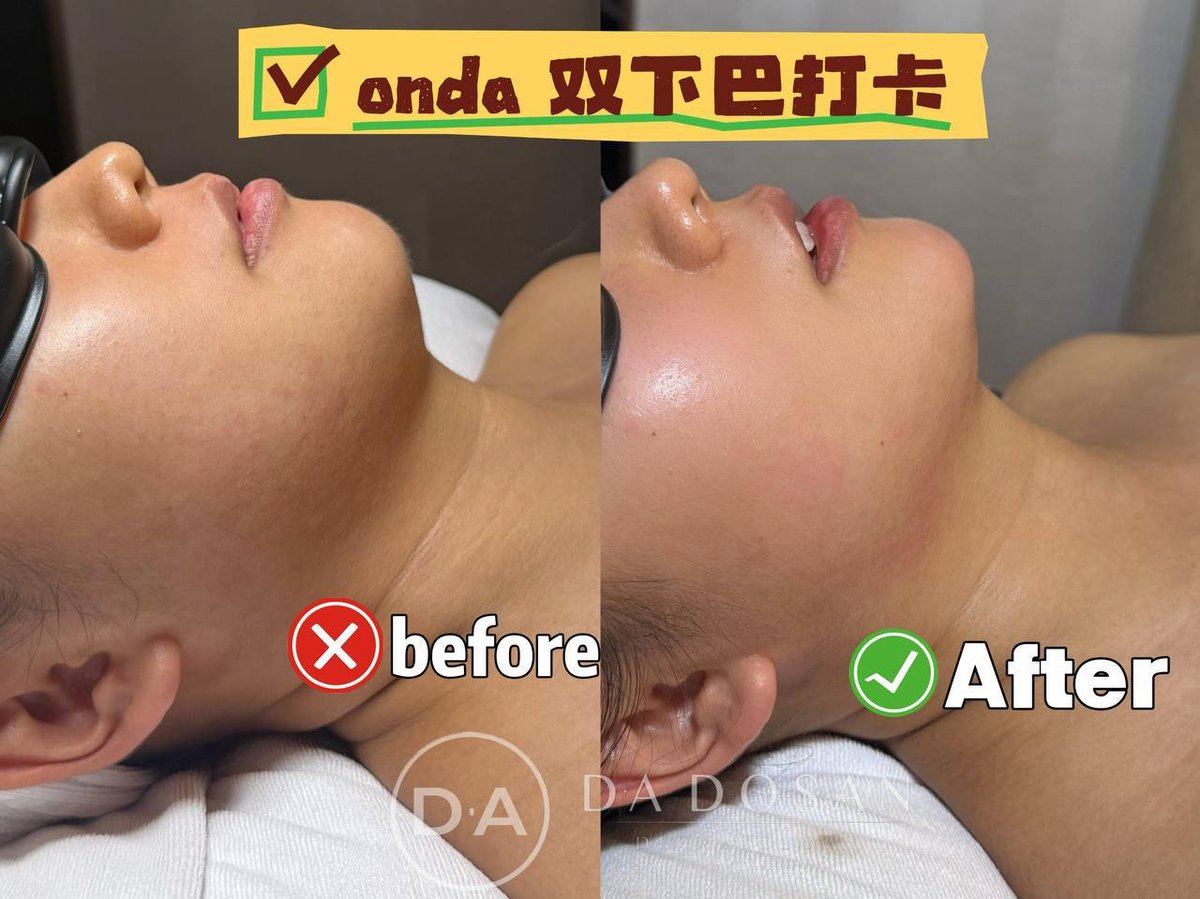 Onda pro非侵入式塑形服务 改善下颌线及腰腹赘肉