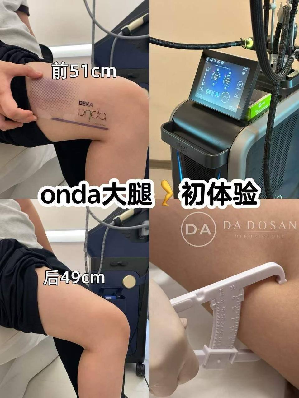 Onda溶脂黑科技美容服务 柬埔寨等多地可预约