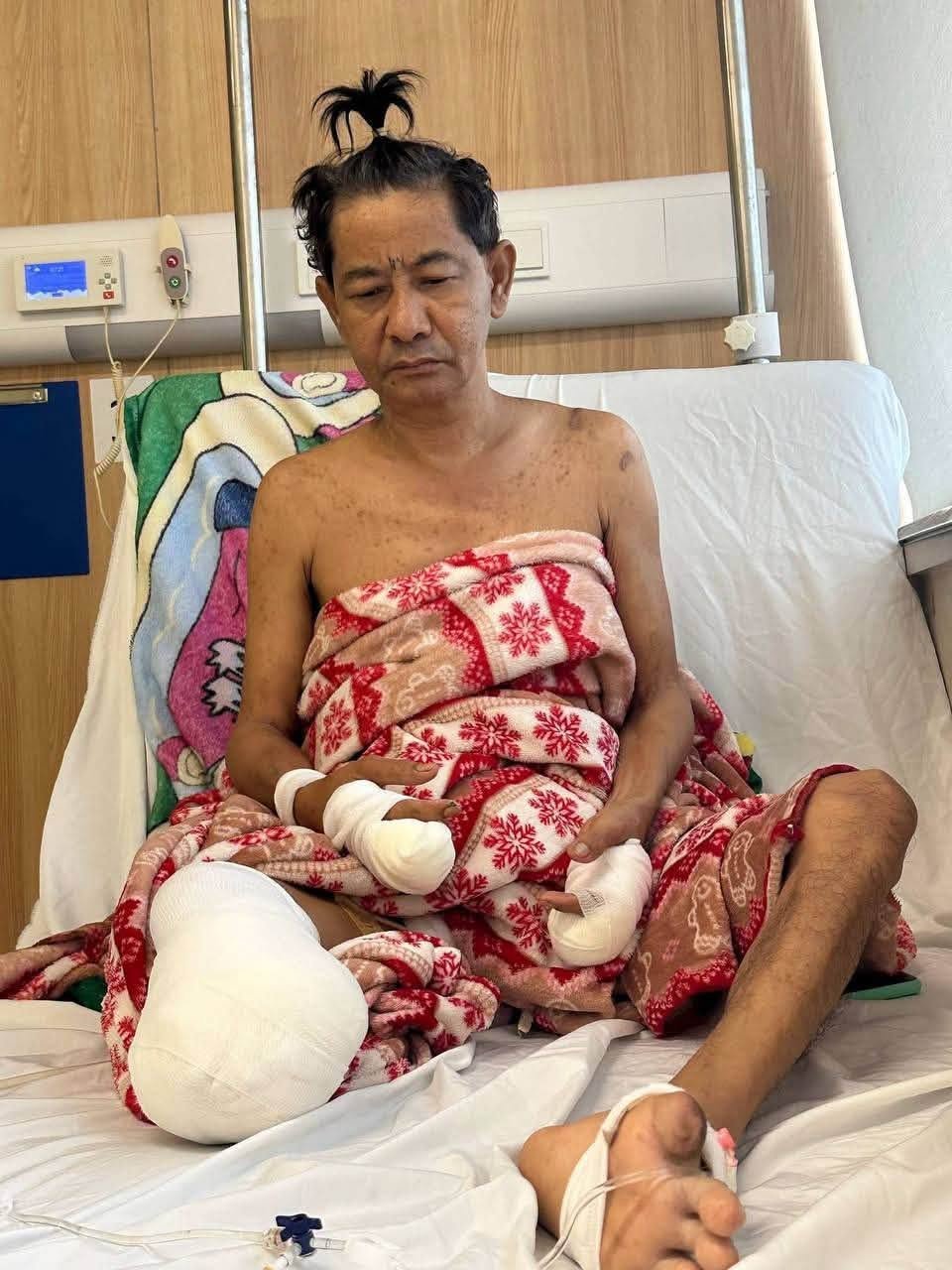 柬埔寨喜剧演员奈塔西因糖尿病恶化被迫截肢