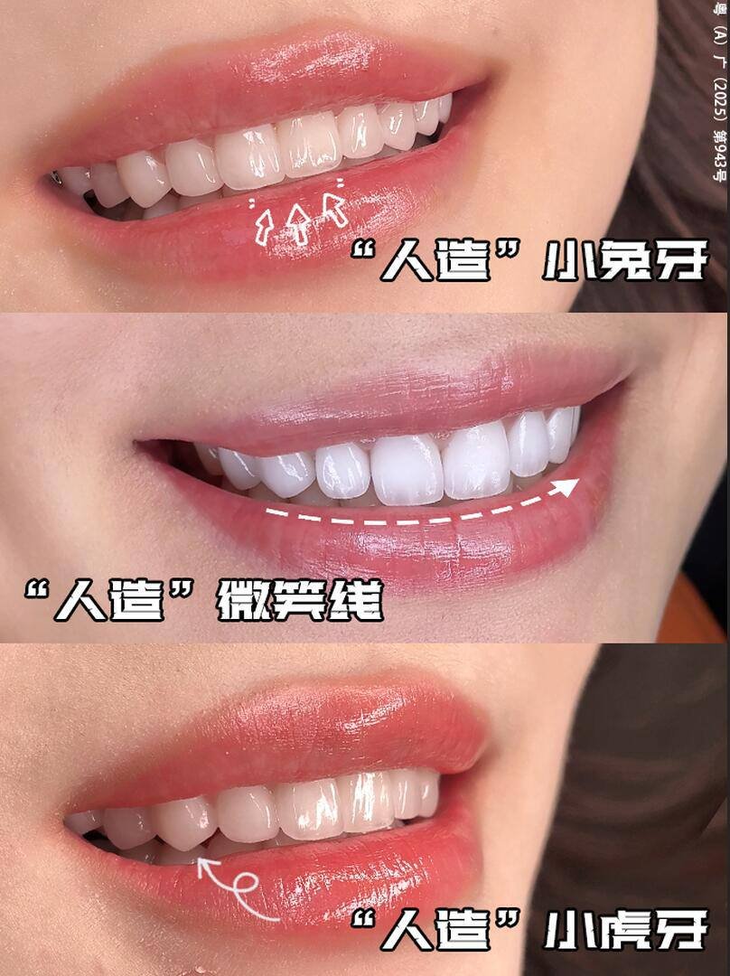 金边牙齿美学定制服务 16颗美牙$6800