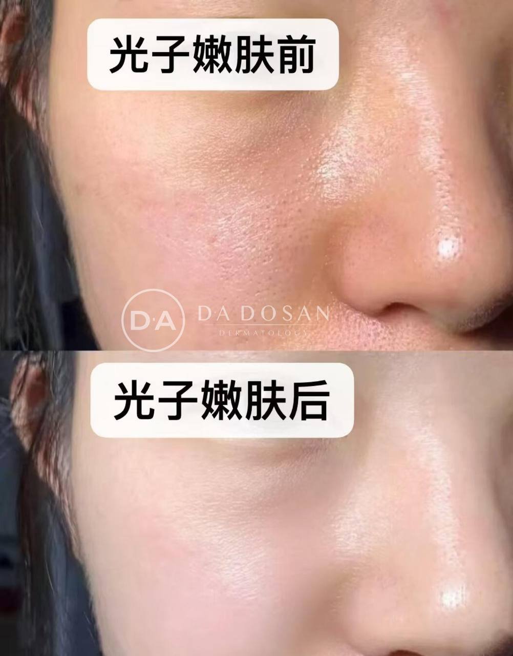 光子嫩肤医美护理建议 坚持月度保养延缓衰老