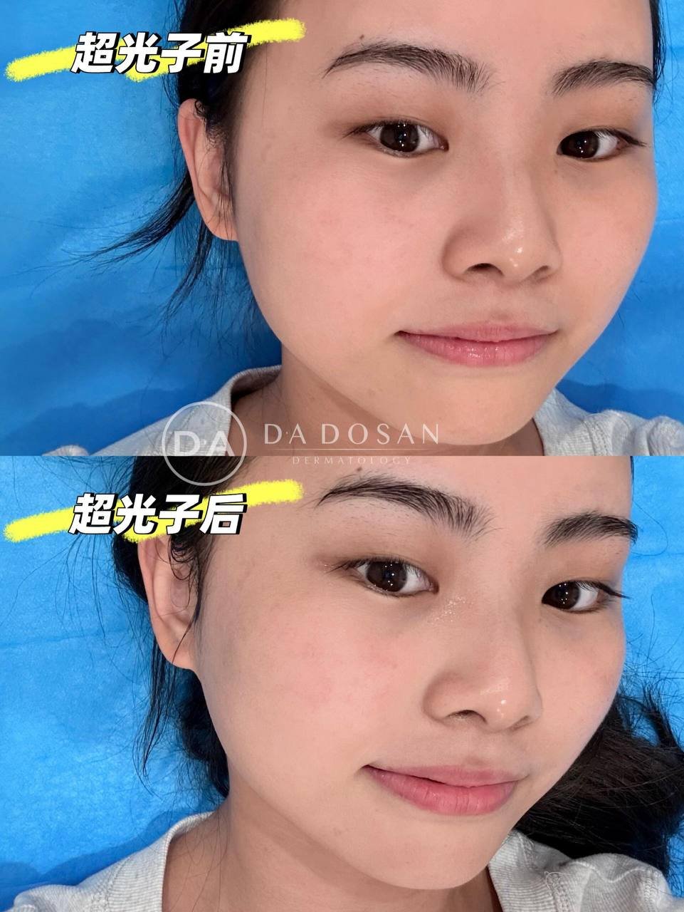 光子嫩肤医美护理建议 坚持月度保养延缓衰老