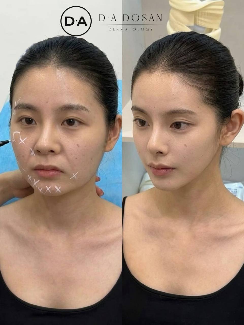 皮贴骨抗衰新方案 紧致提升服务