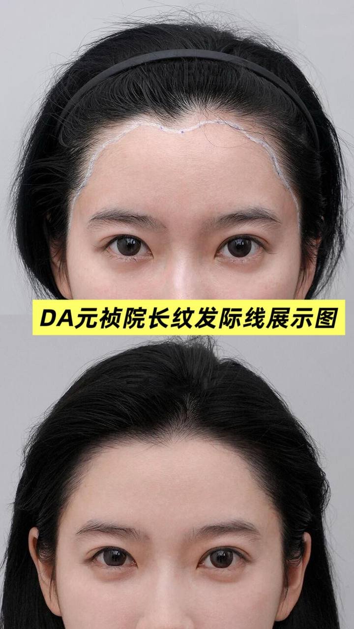 纹发际线服务在柬开业 24小时在线咨询