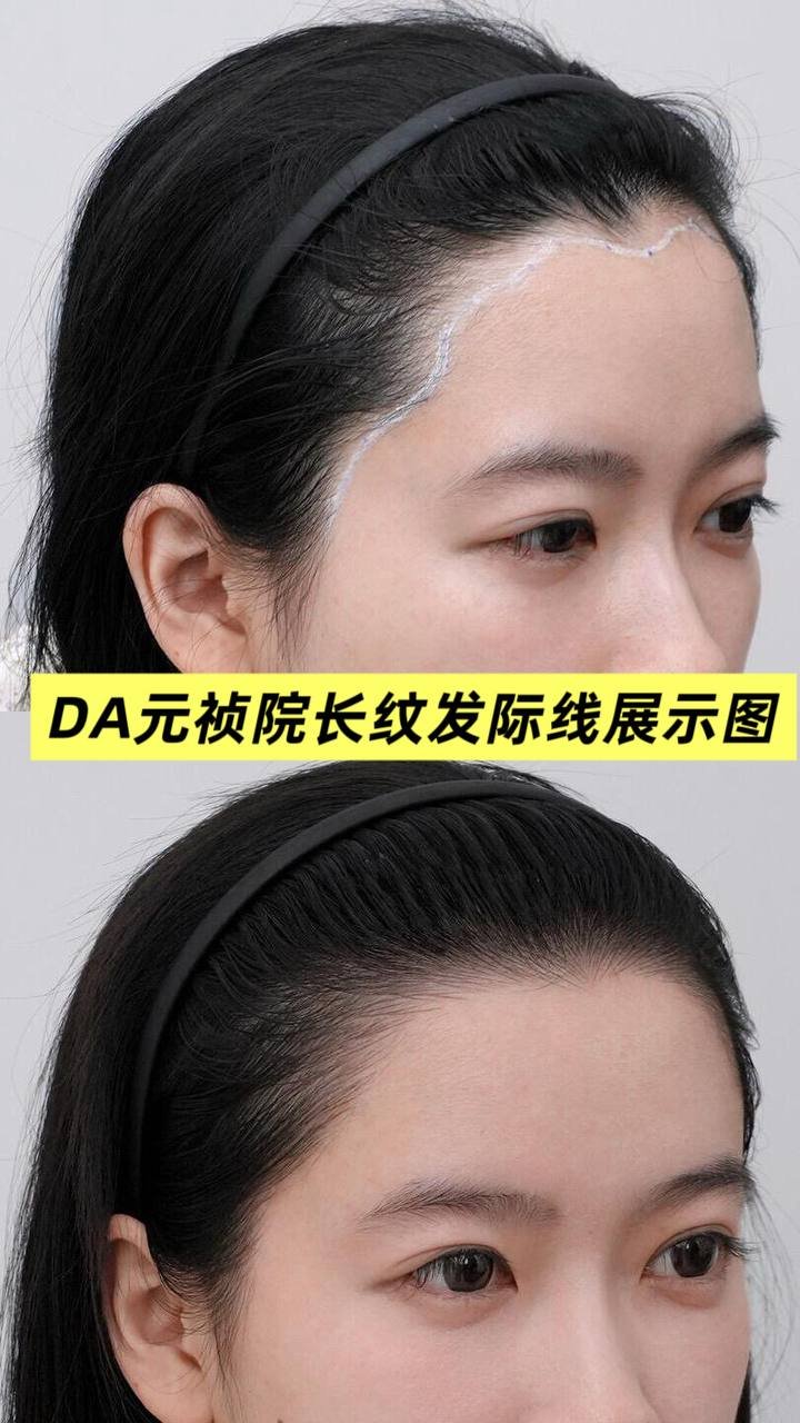 纹发际线服务在柬开业 24小时在线咨询