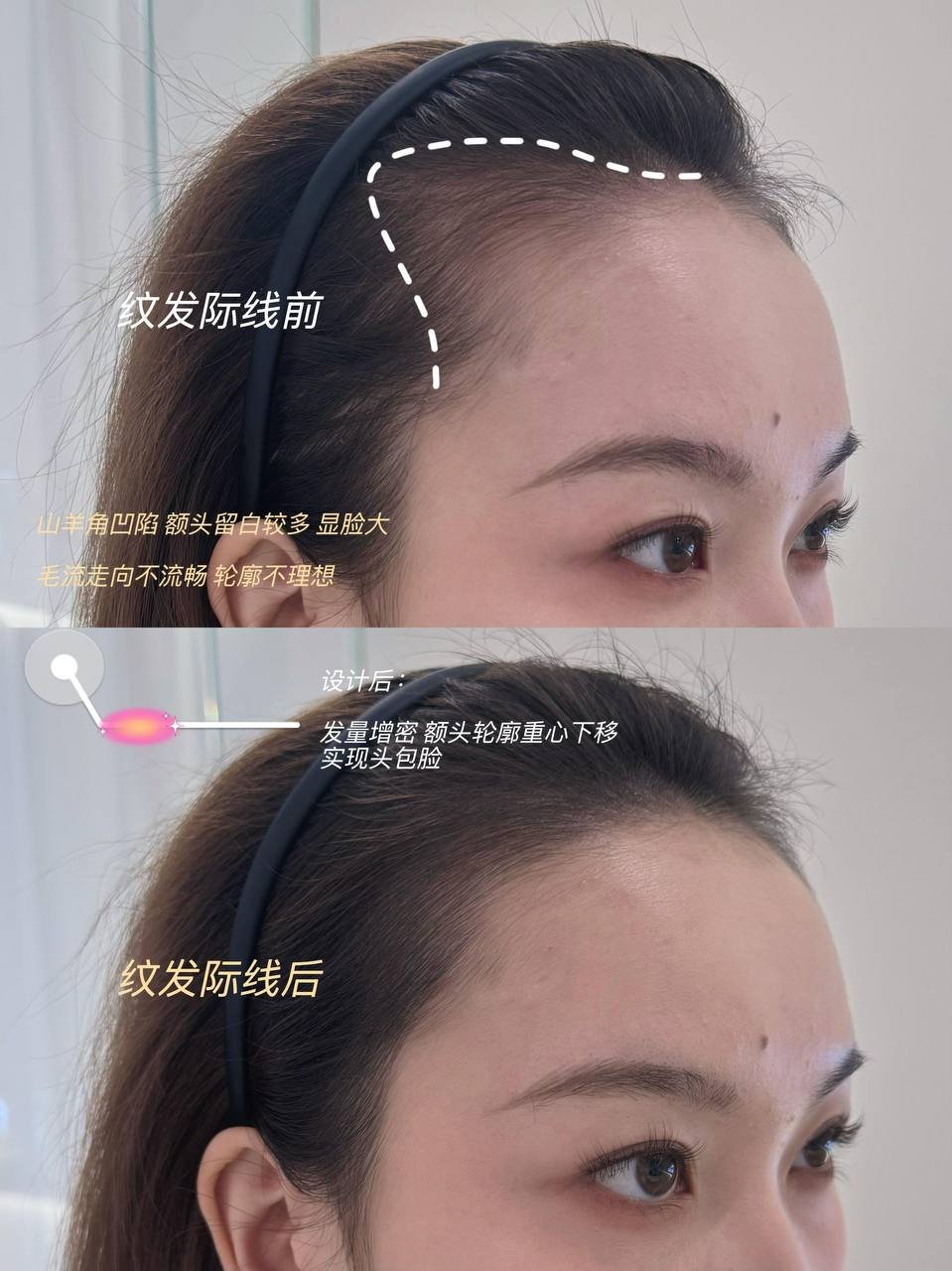 纹发际线服务在柬开业 24小时在线咨询