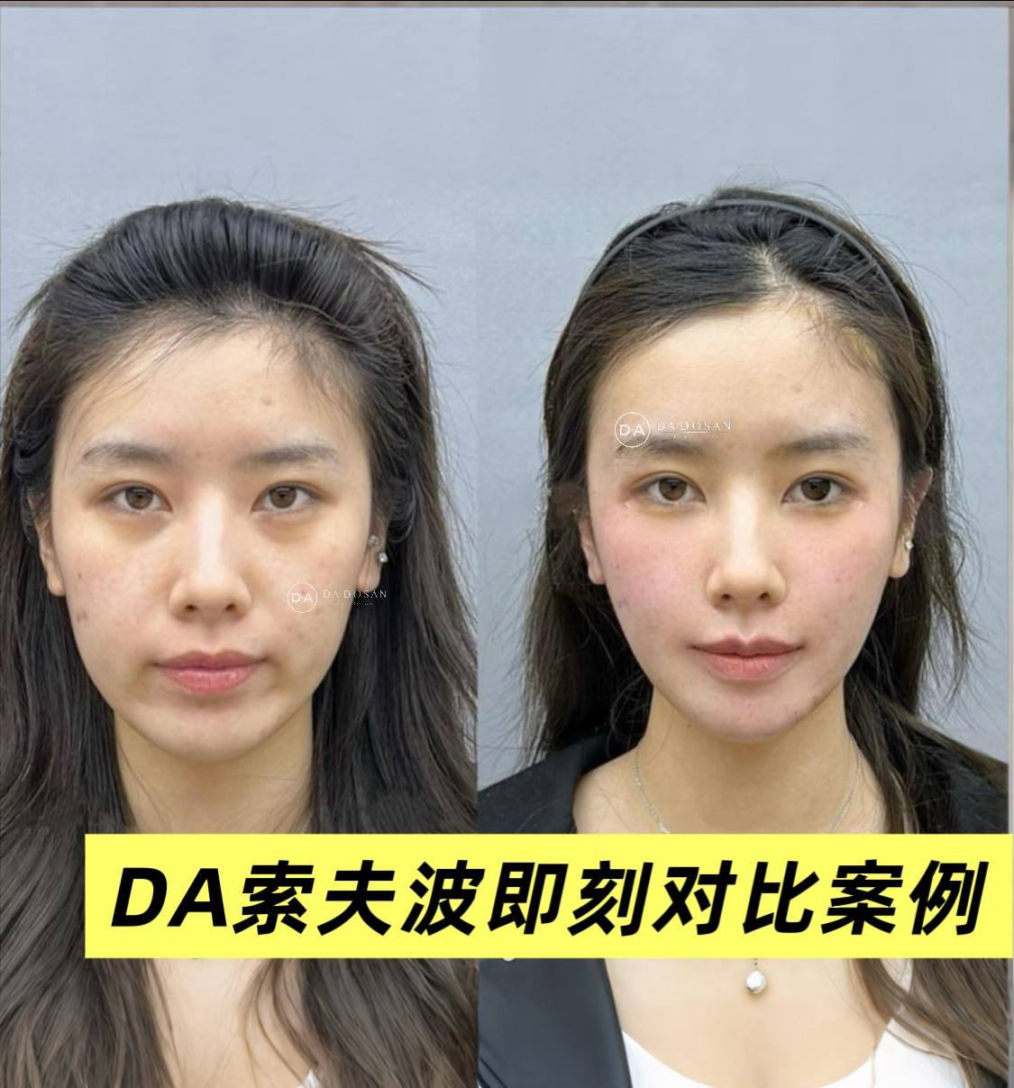 索夫波医美项目推广 适合轻度松弛人群 无恢复期