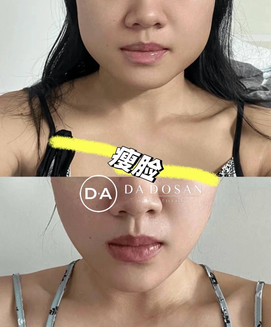 柬埔寨医美服务瘦脸针优惠 $399起多国连锁