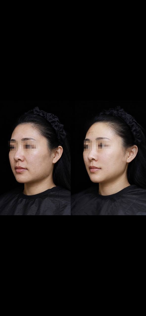 东南亚连锁医美热超联合套餐$1688 仪器保真