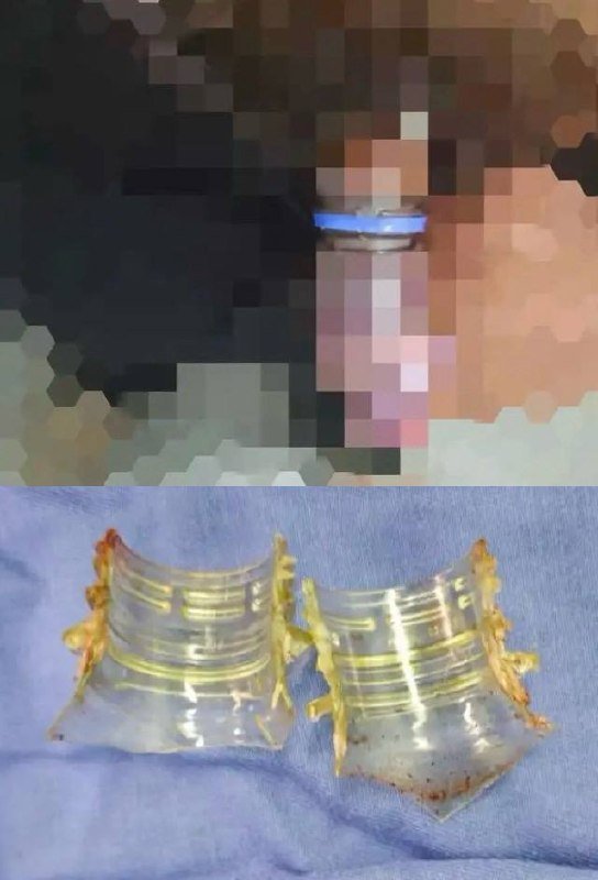 一名50岁男子因一时兴起将可乐瓶套在下体,导致局部充血肿胀无