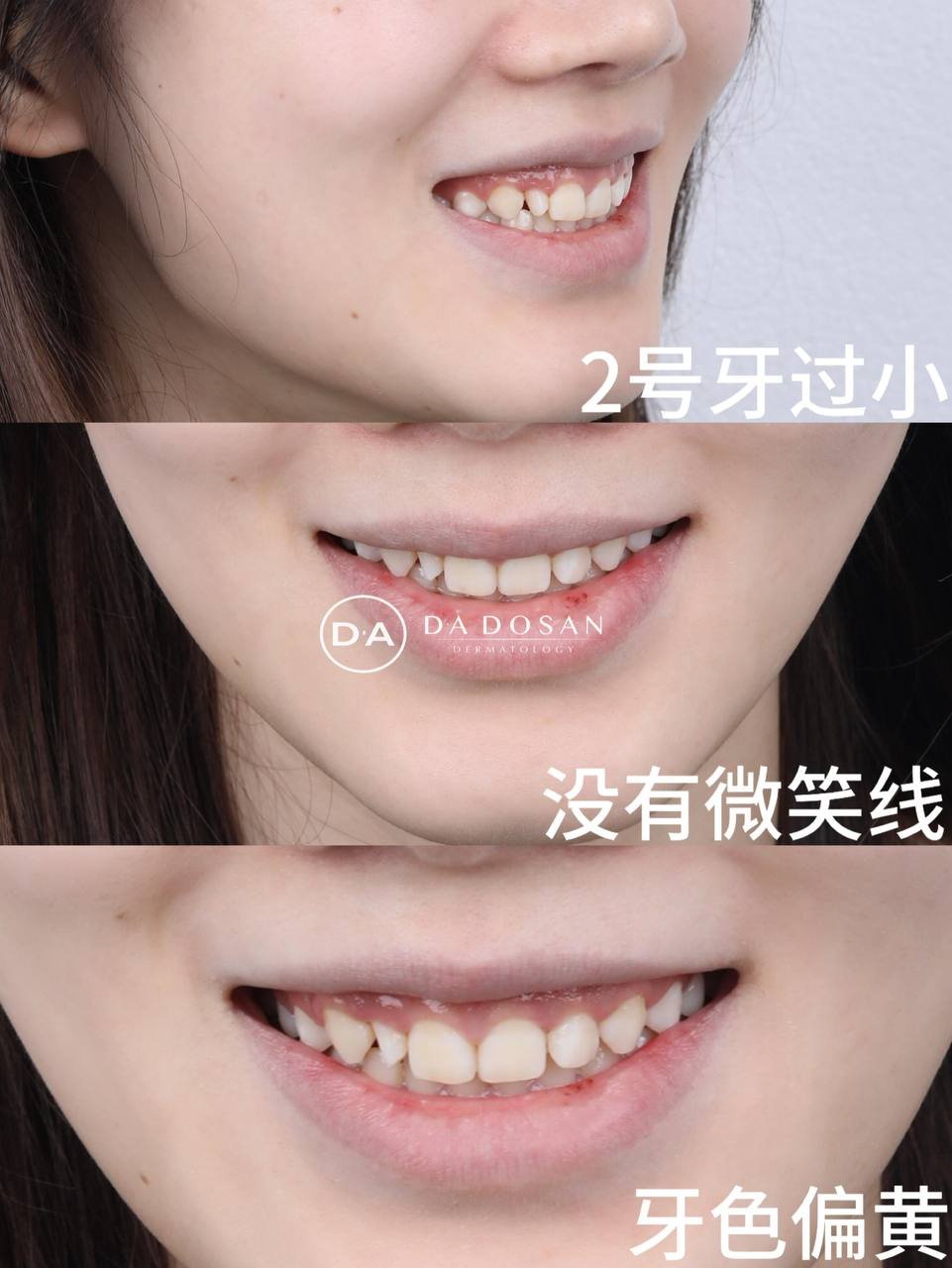 金边牙齿贴面美容改善笑容 少女感自然修复