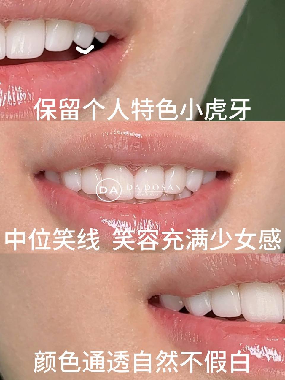 金边牙齿贴面美容改善笑容 少女感自然修复