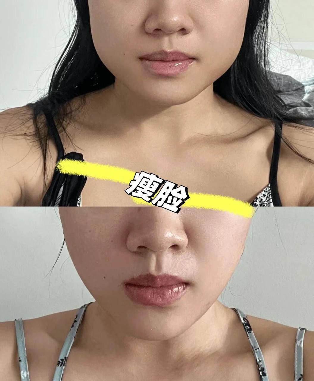 金边医美抗衰瘦脸水光打包价$499 名额有限