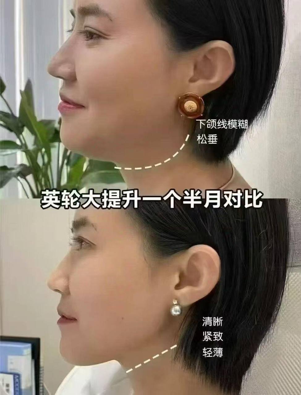 金边医美抗衰瘦脸水光打包价$499 名额有限