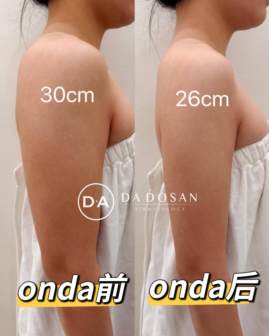 金边ONDA减脂体验 价格优于韩国 隐形赘肉